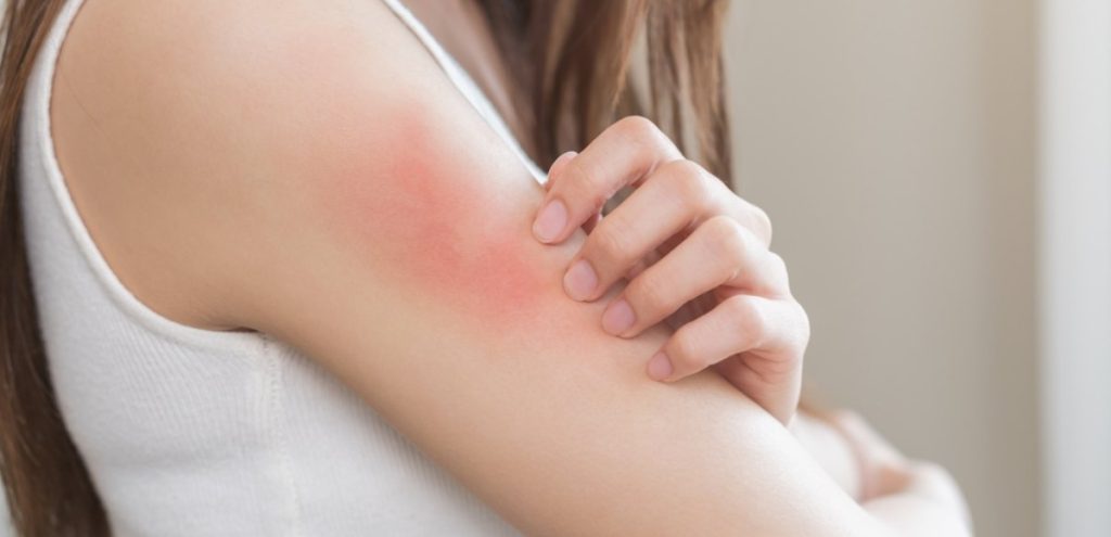 Psoriasi