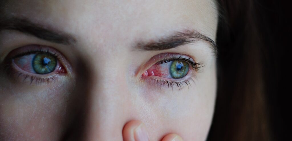 glaucoma
