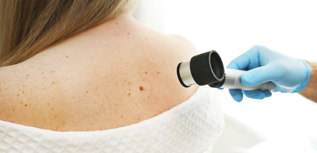 Melanoma Santagostino Imola