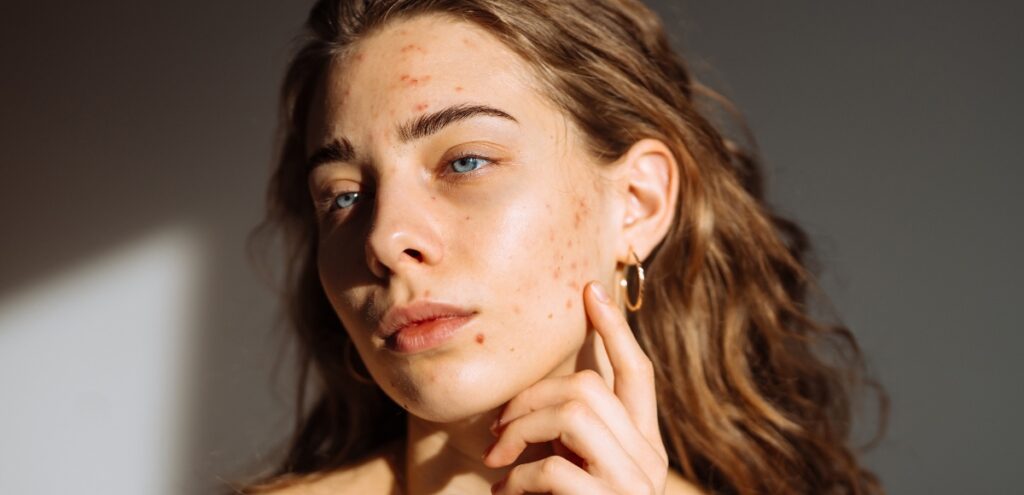 acne