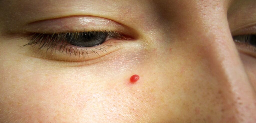angioma