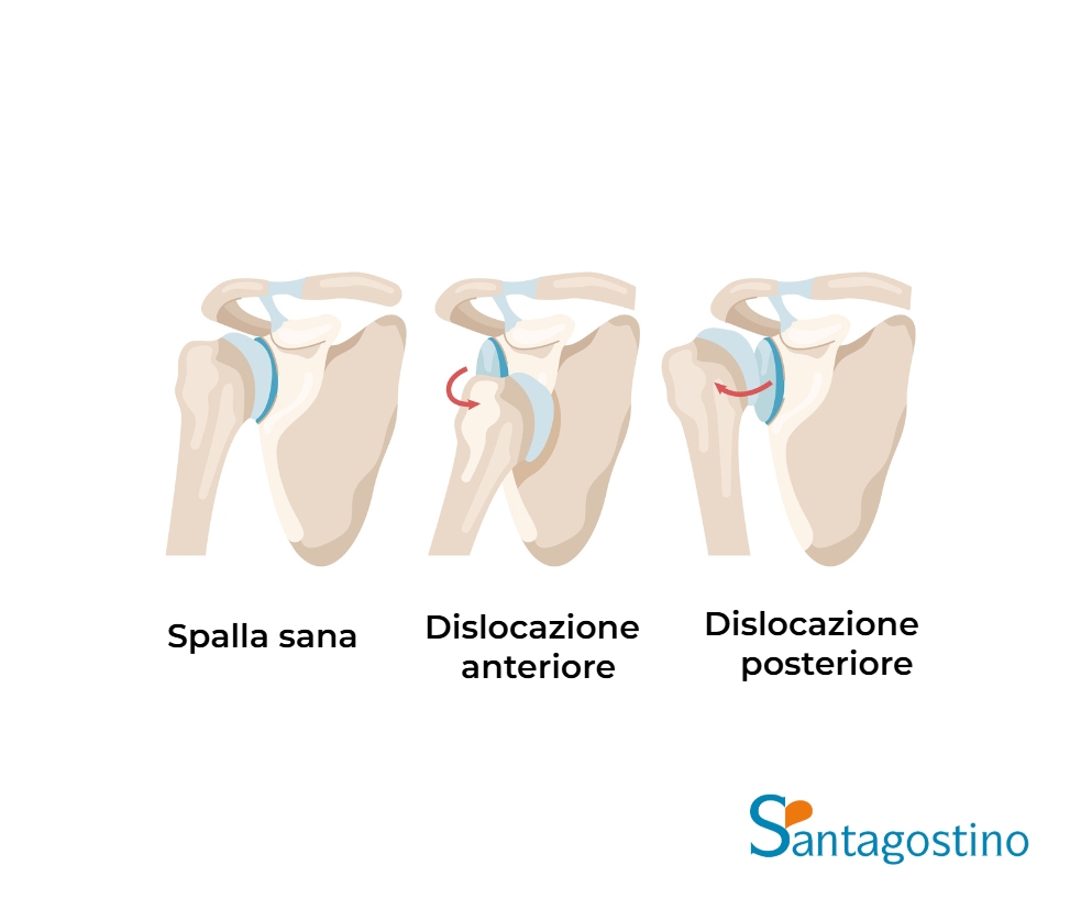 tipi di lussazione santagostino imola