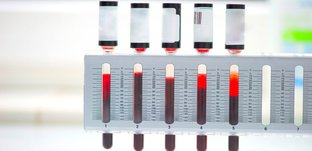 velocità di eritrosedimentazione