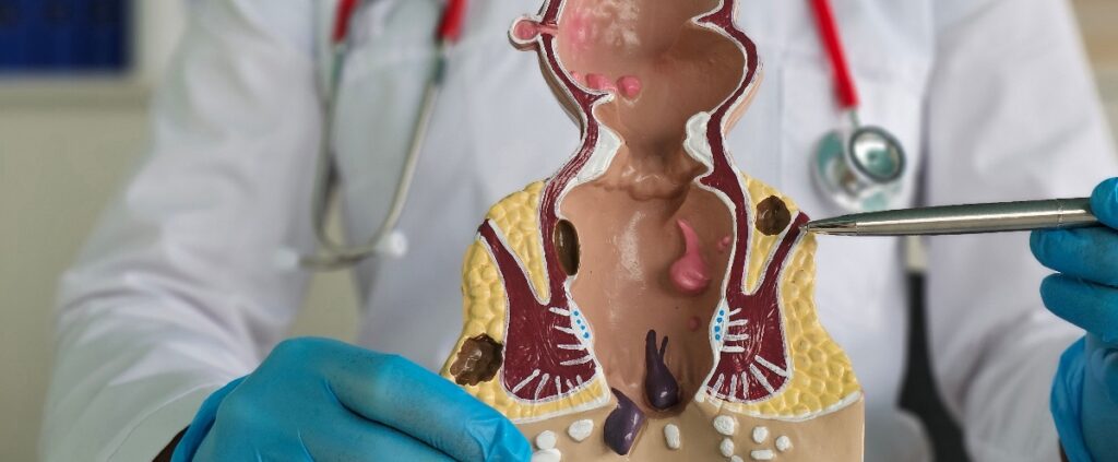 Rettosigmoidoscopia santagostino imola