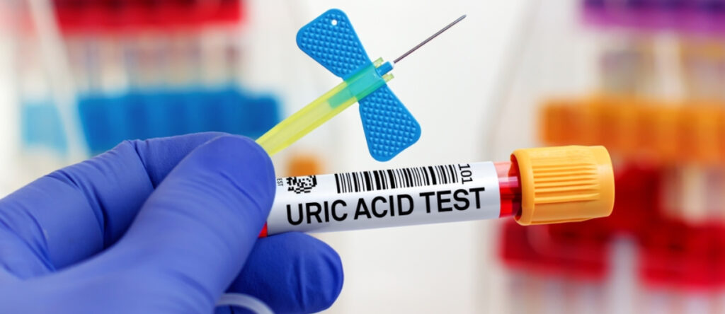 iperuricemia santagostino imola