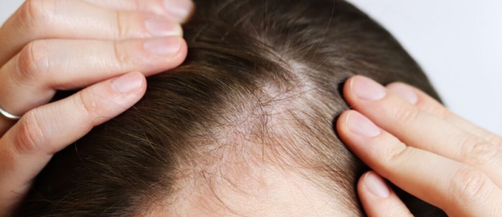 caduta dei capelli imola