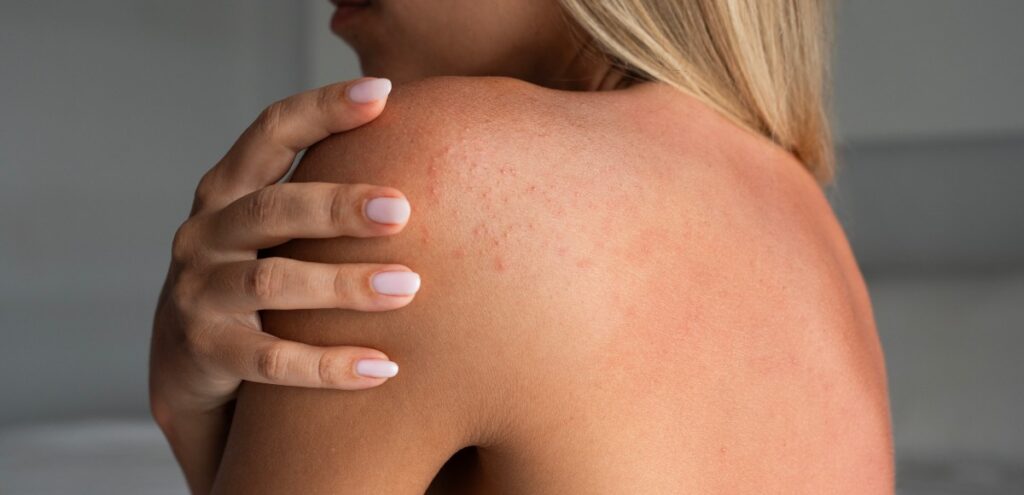 reazione cutanea allergia nichel